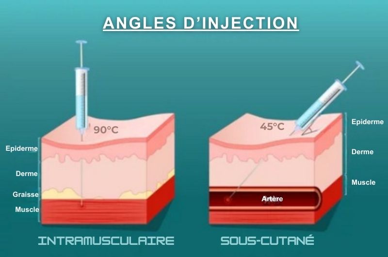 injection sous-cutanée